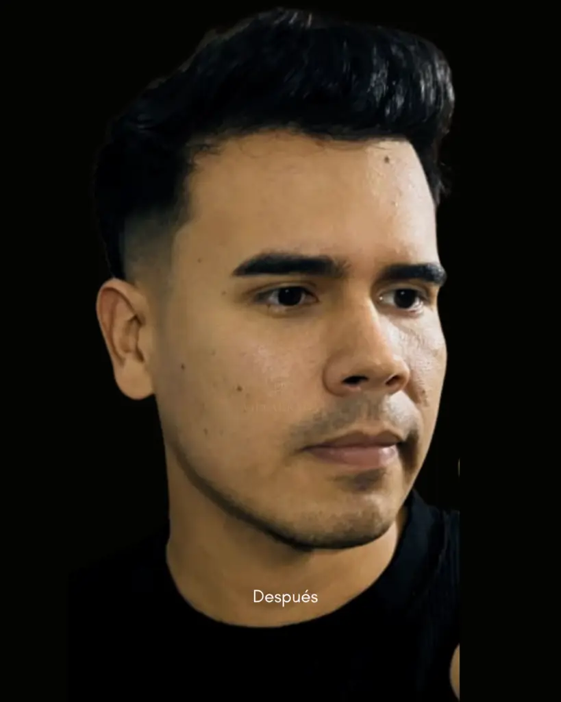 Implante capilar, después — caso 02, línea capilar, Dra. Haidy Villarraga