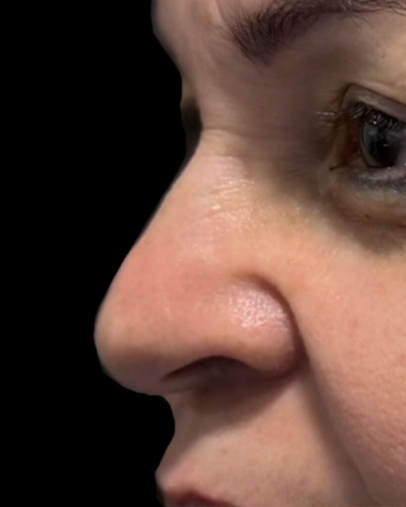Rinoplastia, antes — caso 02, Dra. Haidy Villarraga