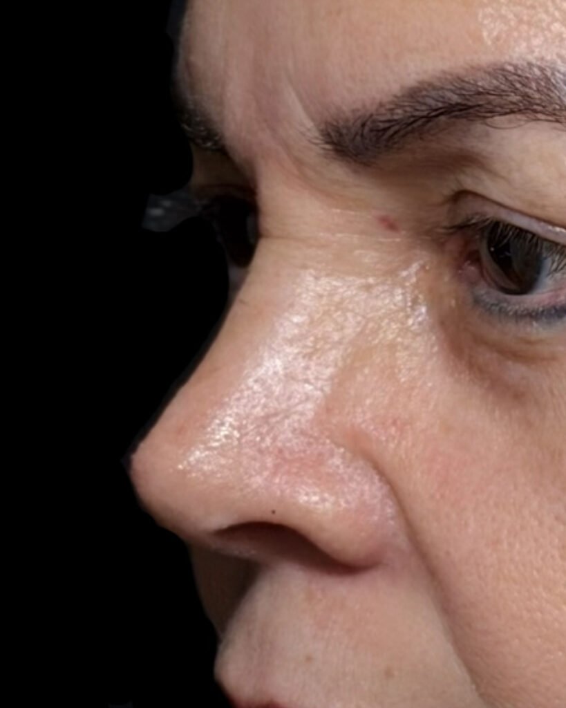 Rinoplastia, después — caso 02, Dra. Haidy Villarraga