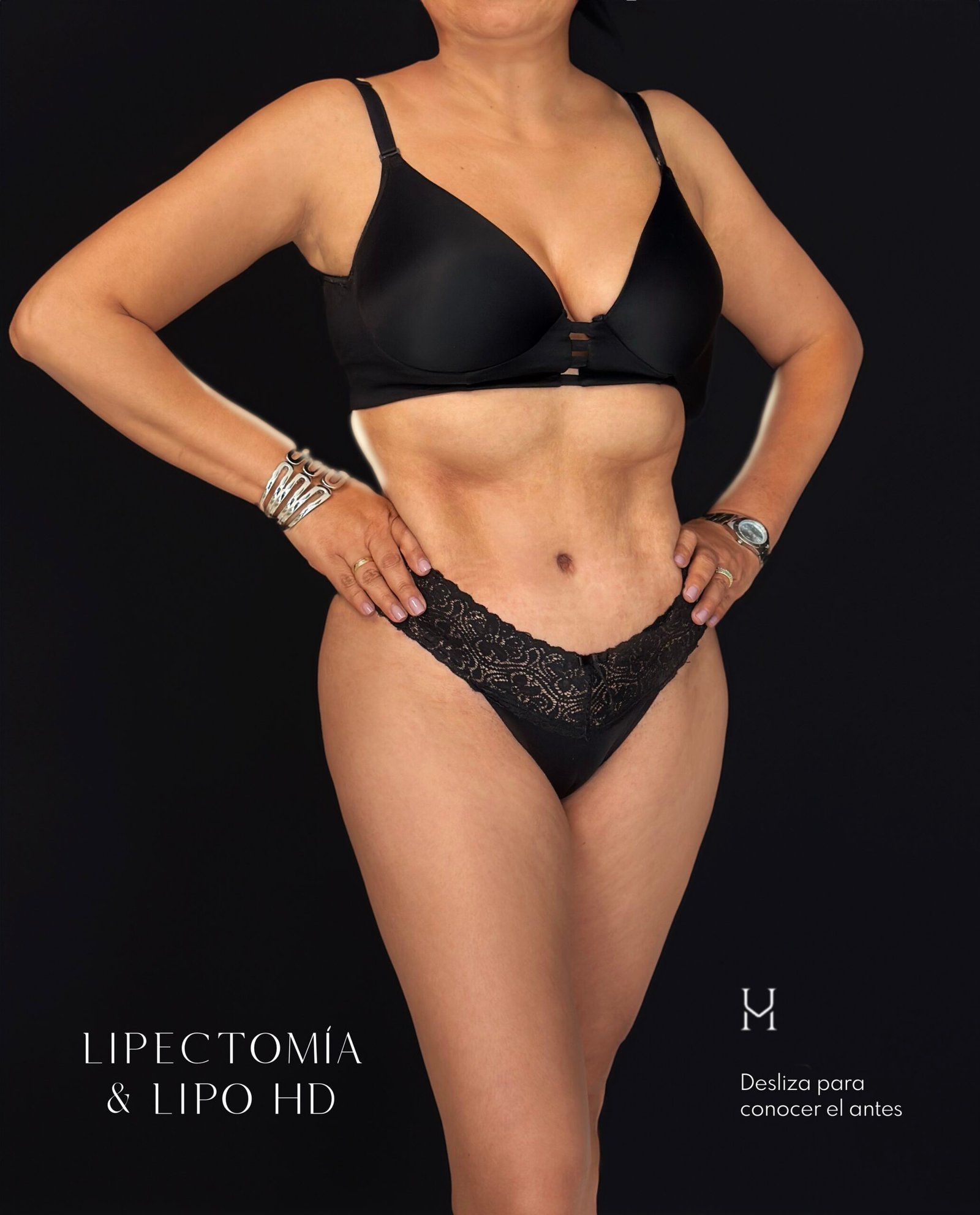 Contorno corporal, después — caso 02, lipectomía y lipo HD, Dra. Haidy Villarraga