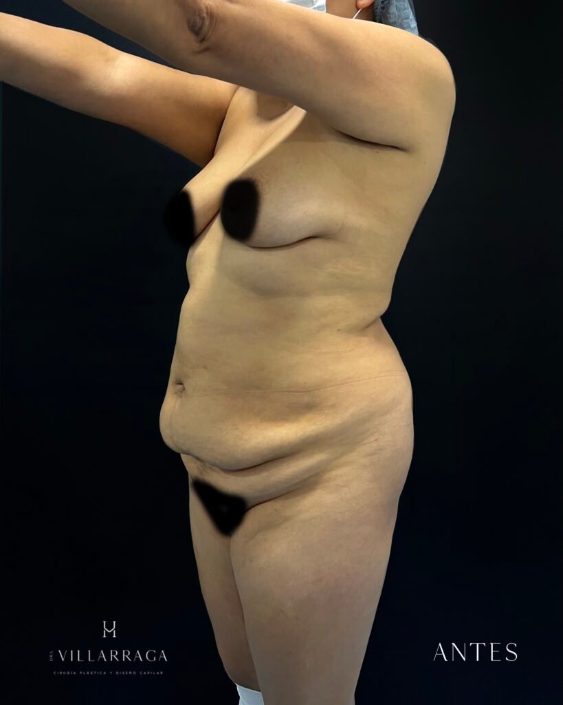 Contorno corporal, antes — caso 02, lipectomía y lipo HD, Dra. Haidy Villarraga
