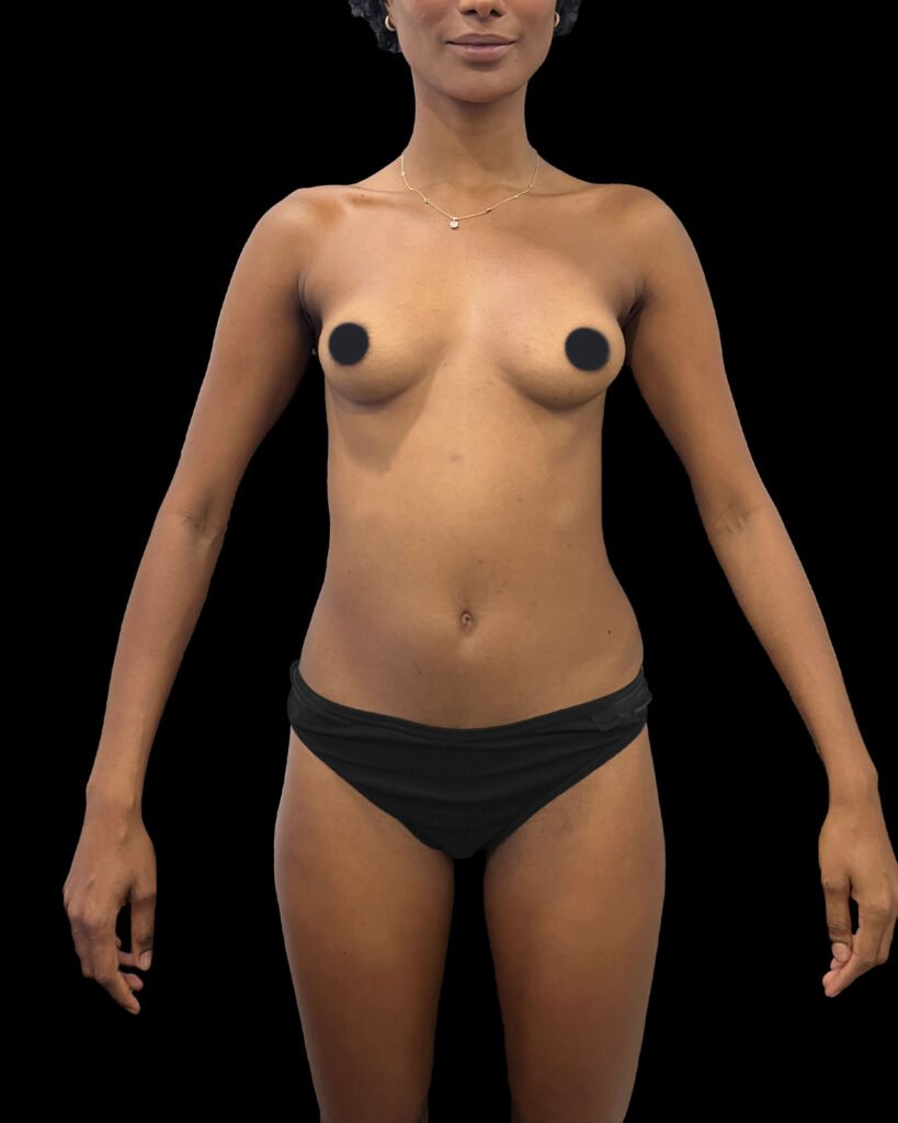 Contorno corporal, antes — caso 01, Dra. Haidy Villarraga