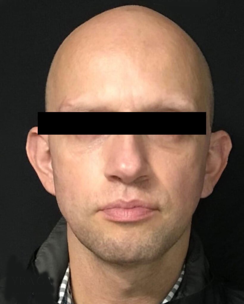 Lifting facial, después — caso 01, Dra. Haidy Villarraga