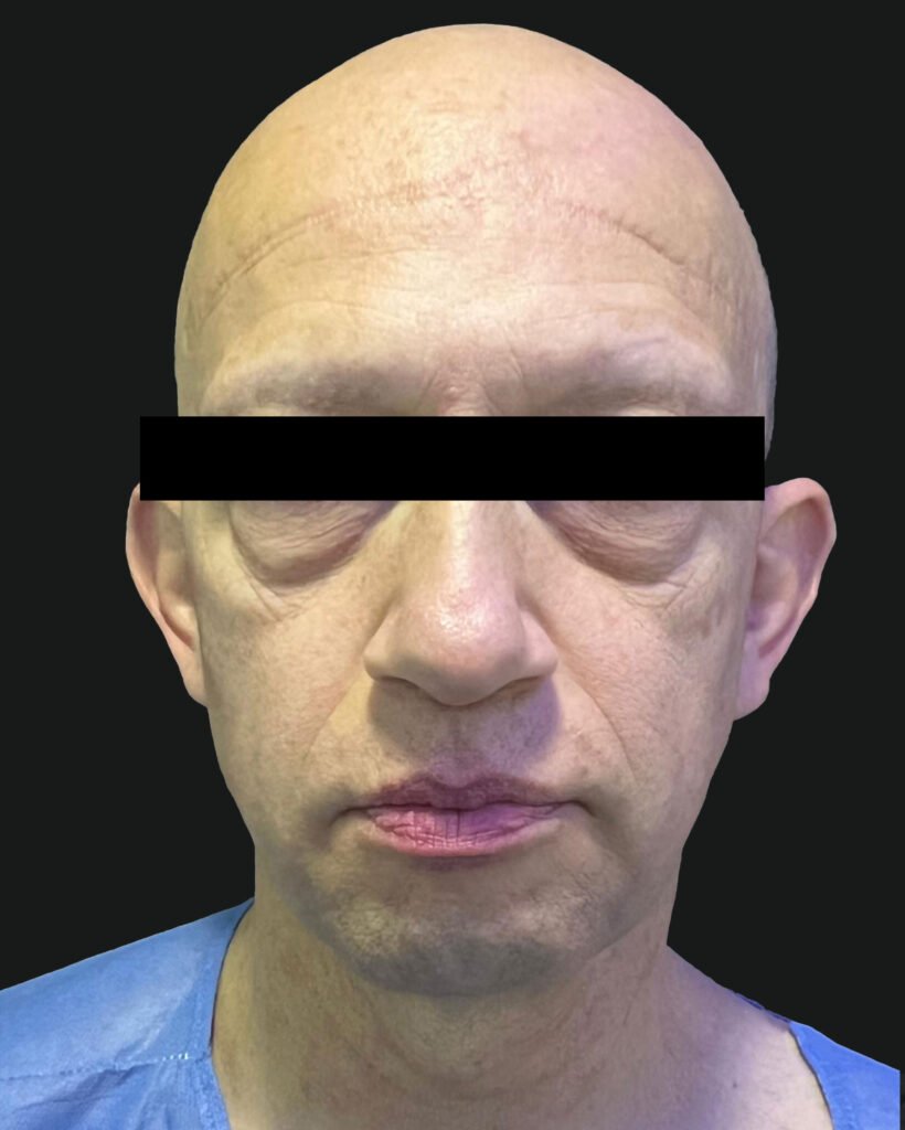 Lifting facial, antes — caso 01, Dra. Haidy Villarraga