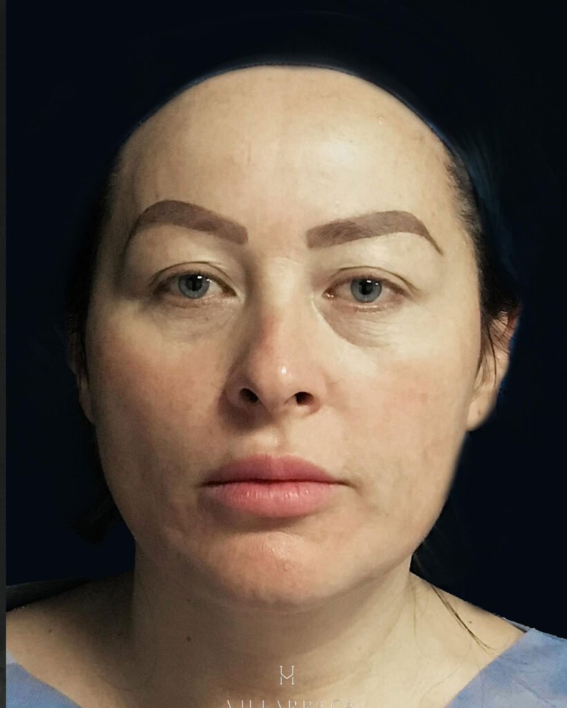 Lifting facial, antes — caso 02, Dra. Haidy Villarraga