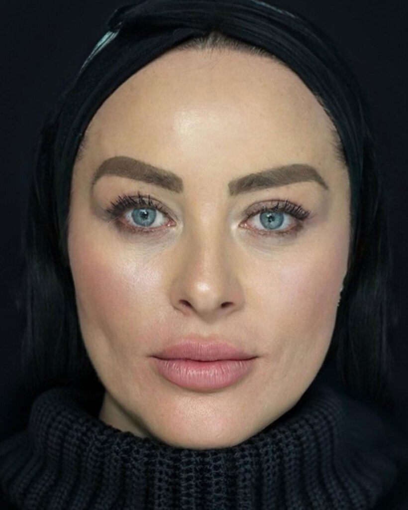 Lifting facial, después — caso 02, Dra. Haidy Villarraga
