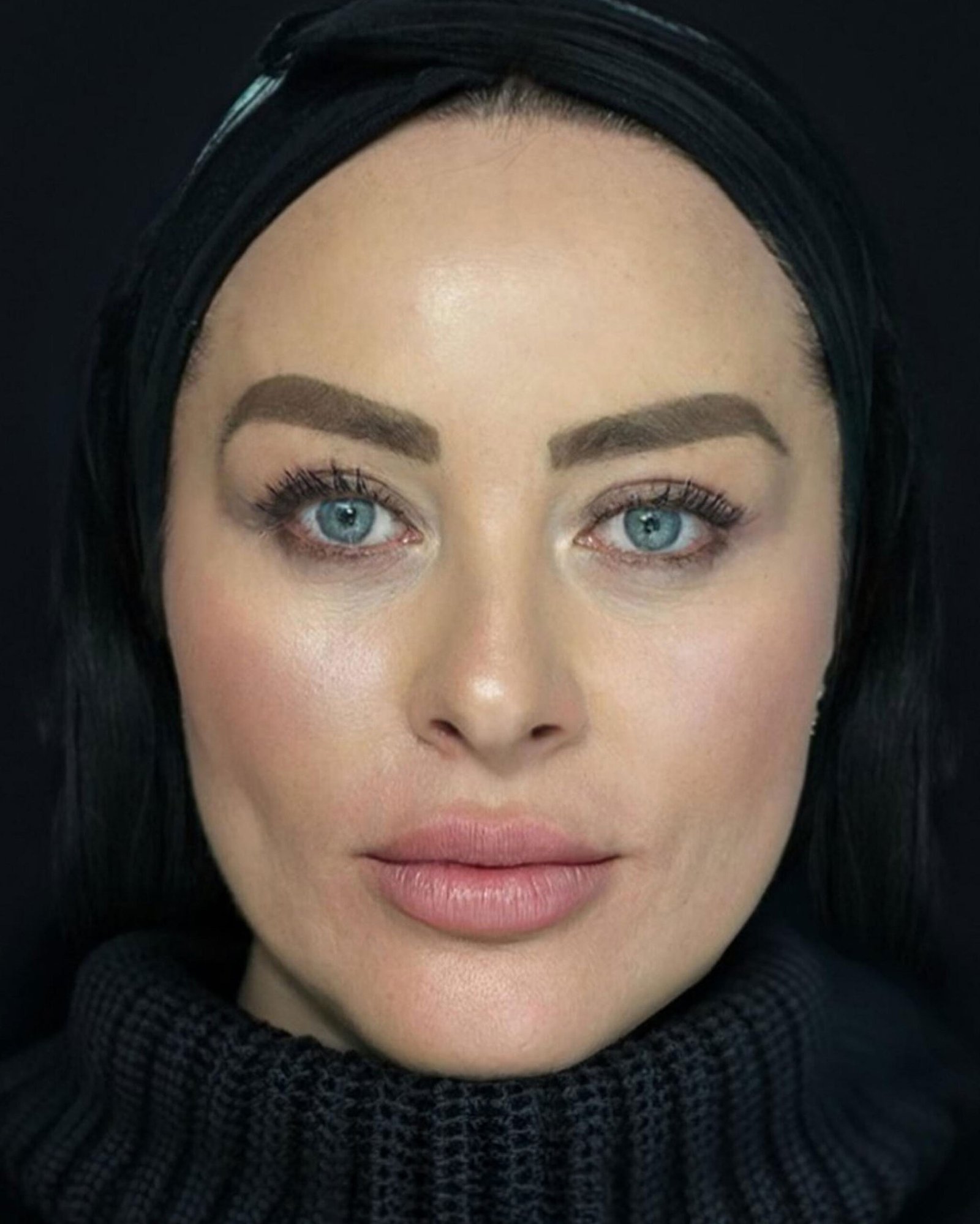 Lifting facial, después — caso 02, Dra. Haidy Villarraga
