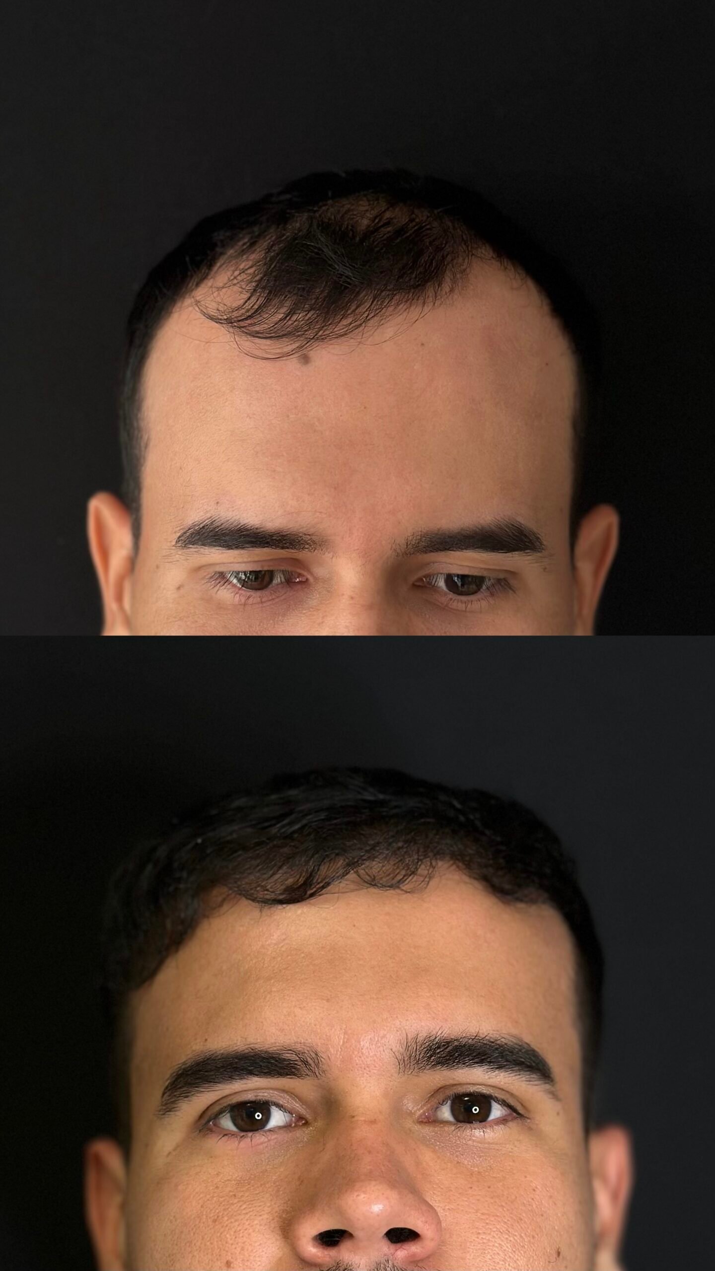 Implante capilar, antes y después — Dra. Haidy Villarraga